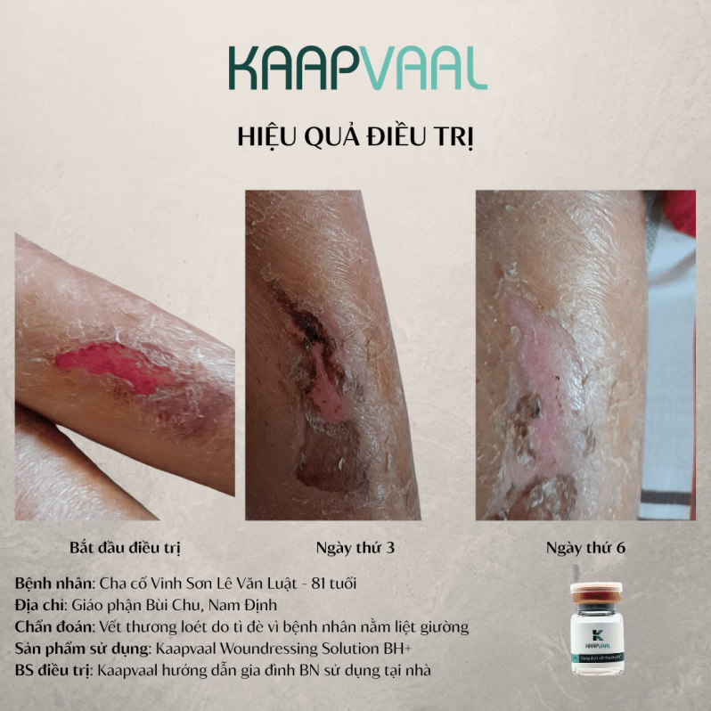 Hiệu quả điều trị của sản phẩm Kaapvaal