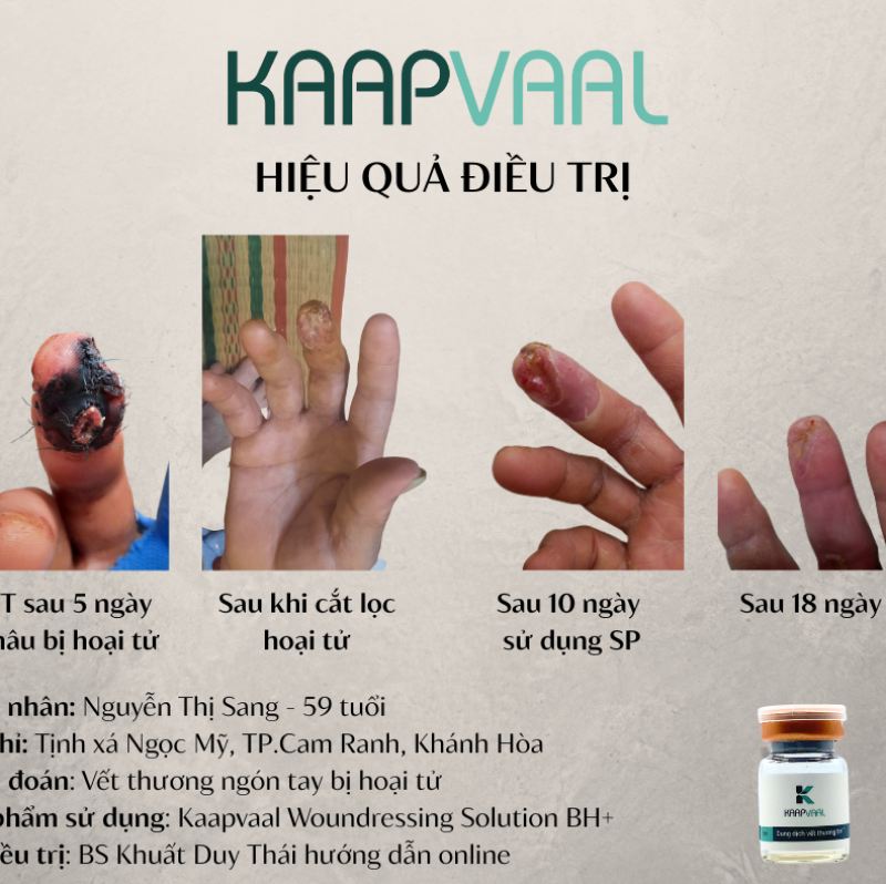 Hiệu quả điều trị của sản phẩm Kaapvaal