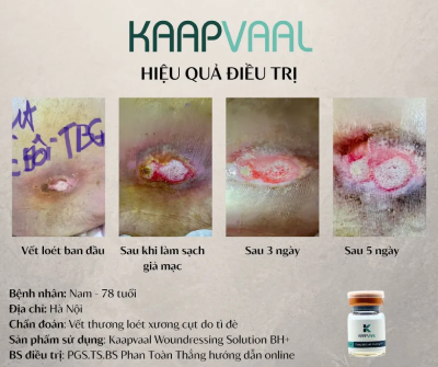 Hiệu quả điều trị của sản phẩm Kaapvaal